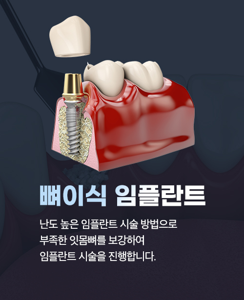 뼈이식 임플란트