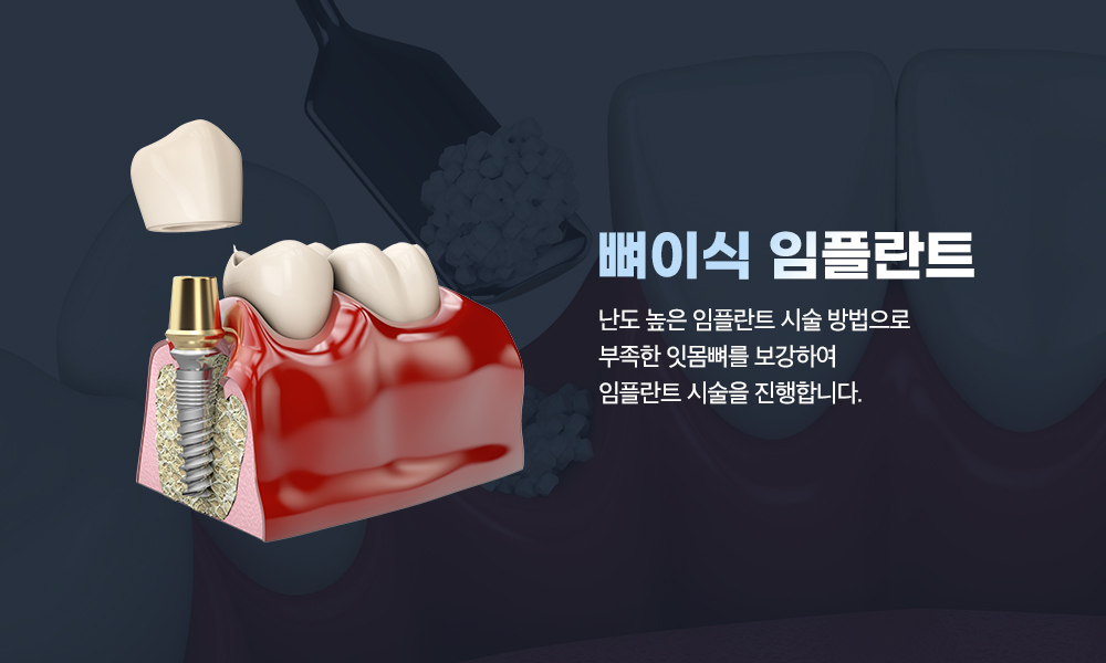 뼈이식 임플란트