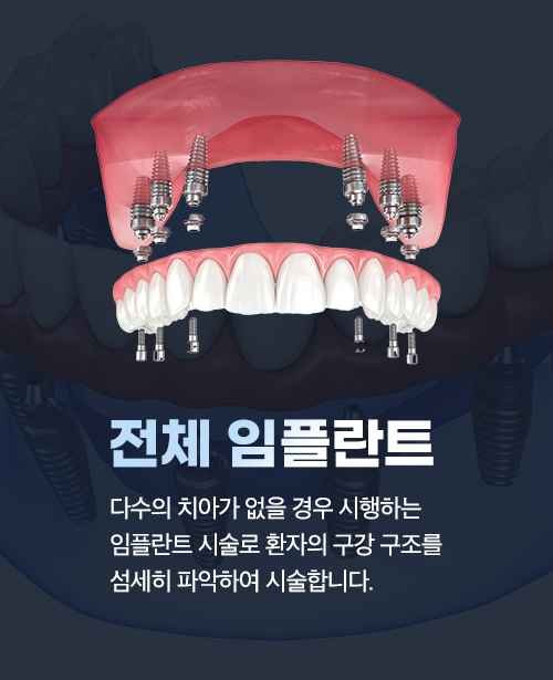 전체 임플란트
