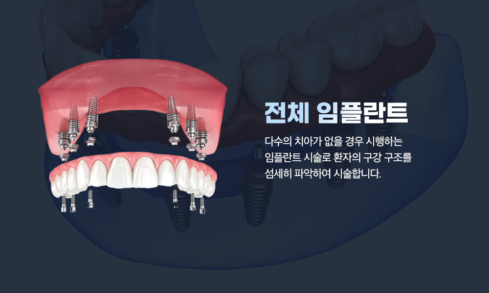 전체 임플란트