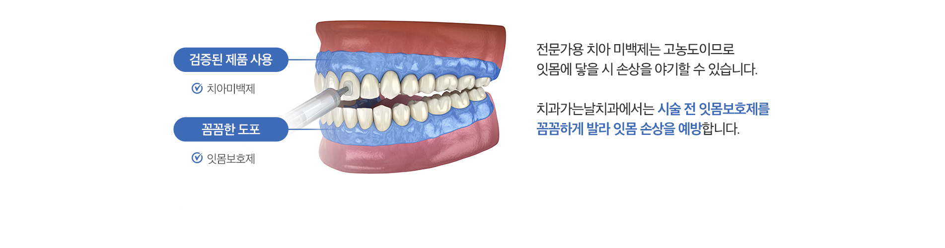 시술 전 잇몸보호제를 꼼꼼하게 발라 잇몸 손상을 예방