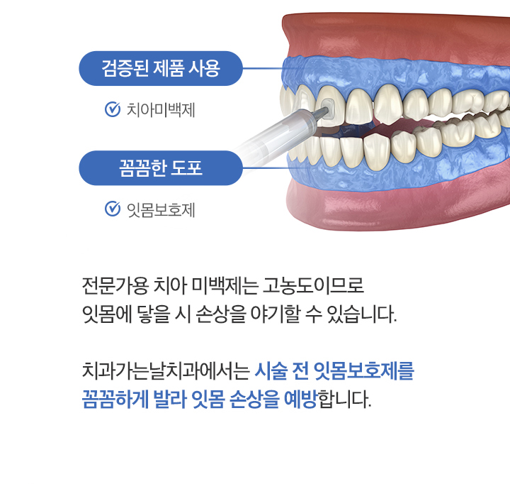 시술 전 잇몸보호제를 꼼꼼하게 발라 잇몸 손상을 예방