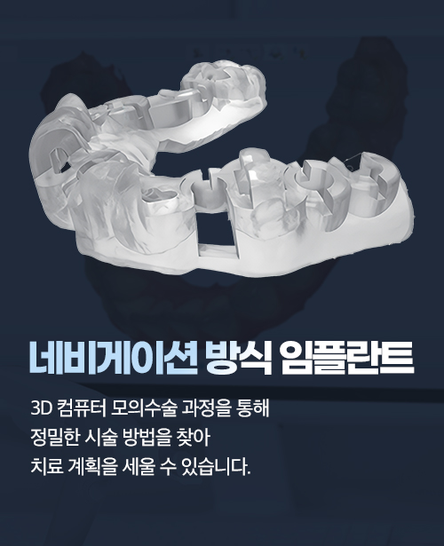디지털 임플란트