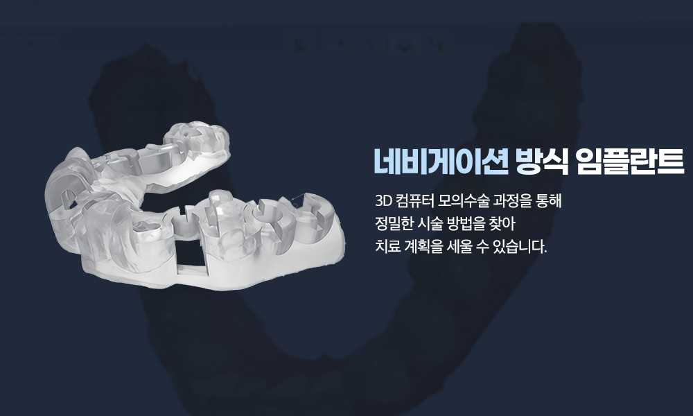 디지털 임플란트